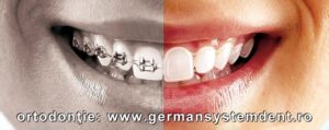 aparat dentar stomatologie