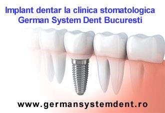 implant dentar