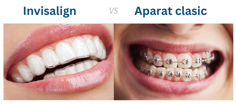aparat dentar invisalign vs aparat clasic
