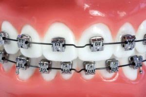 aparat dentar