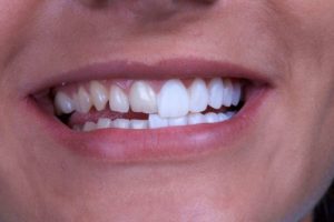 fatete dentare