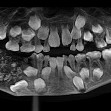 radiografie dentara malformatie