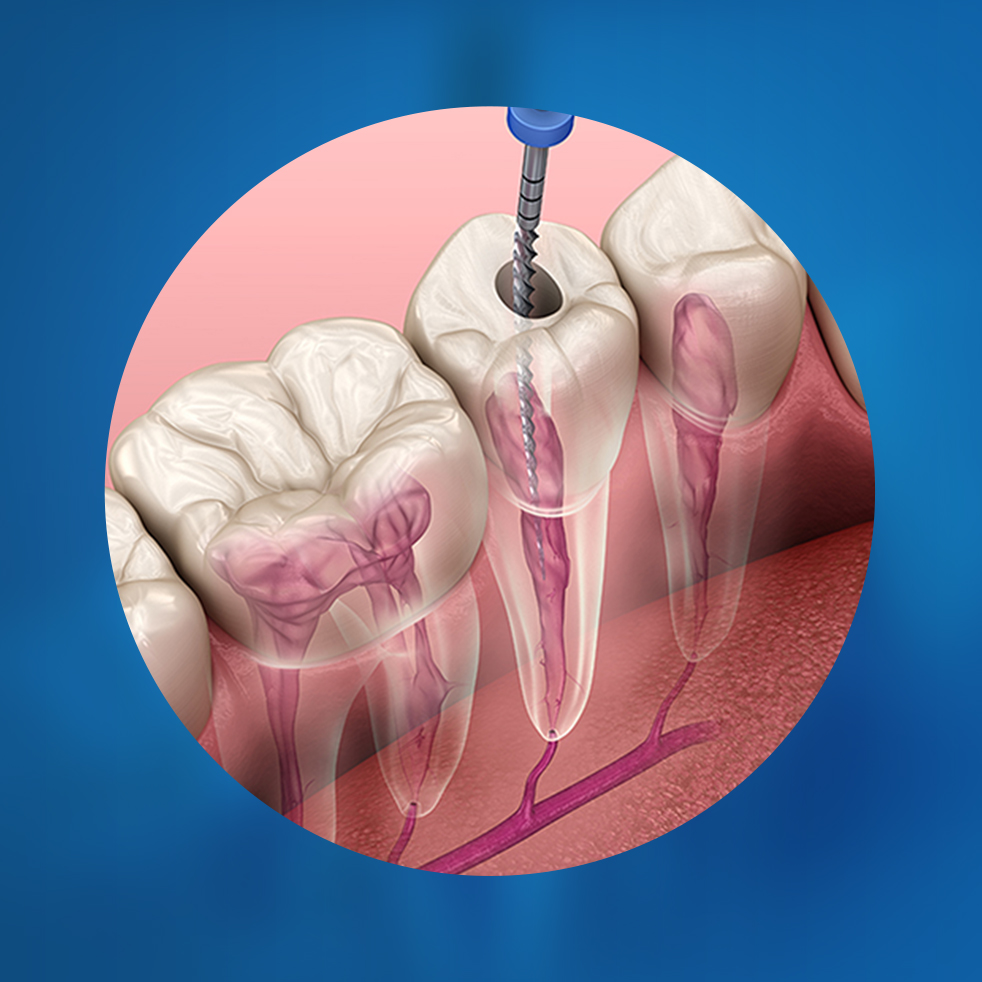endodontie , tratament de canal